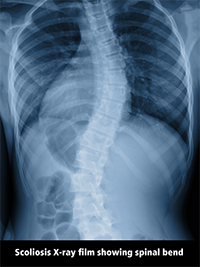 Scoliosis X-ray Film Showing Spinal Bend